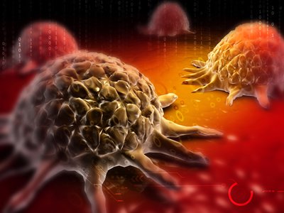 A digital illustration of cancer cells (Courtesy of Creations / Shutterstock Inc.)
